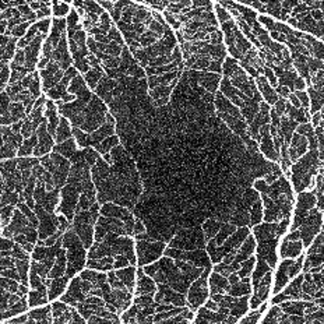 Good Quality Angiogram