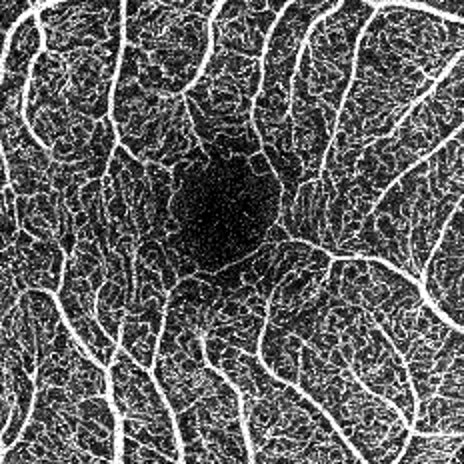 Good Quality Angiogram