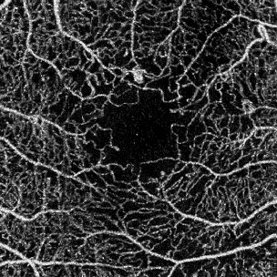Good Quality Angiogram