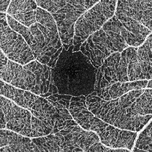 Good Quality Angiogram