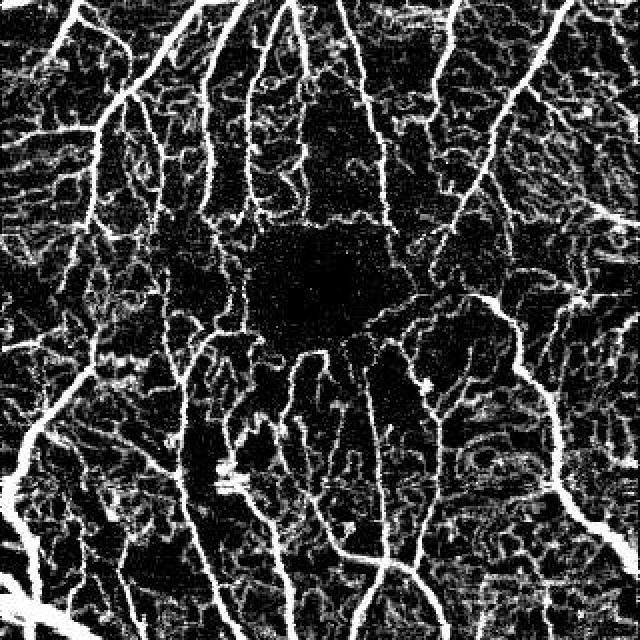 Good Quality Angiogram