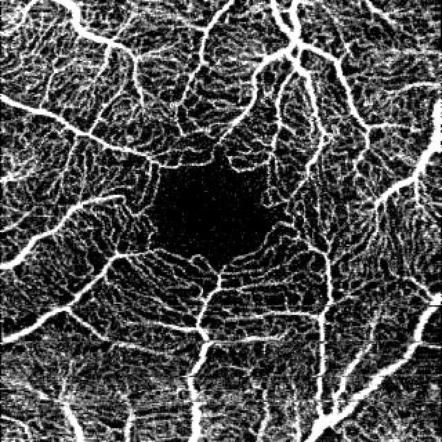 Good Quality Angiogram